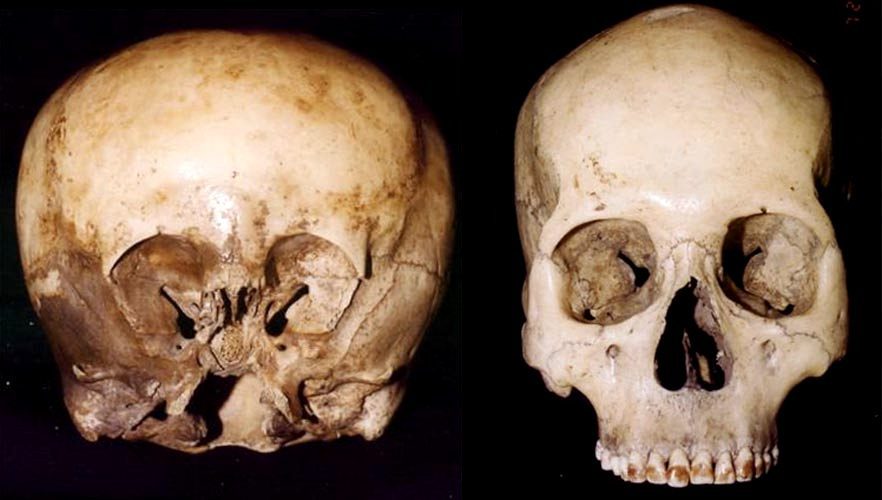 Сравнение черепа Звездного ребенка (слева) с человеческим черепом (справа). «Волокна» и красные остатки, вплетенные в кость черепа Звездного ребенка, напоминают арматуру и увеличивают прочность кости почти в шесть раз сильнее, чем у обычного черепа.