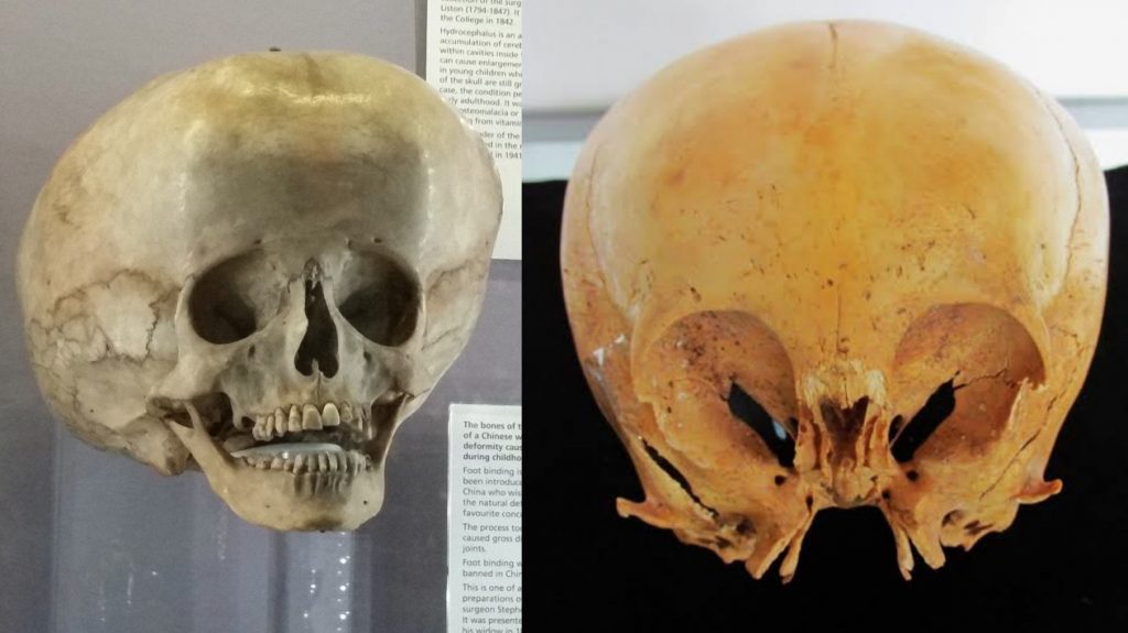 Сравнение черепа с гидроцефалией  и черепа Старчайлда