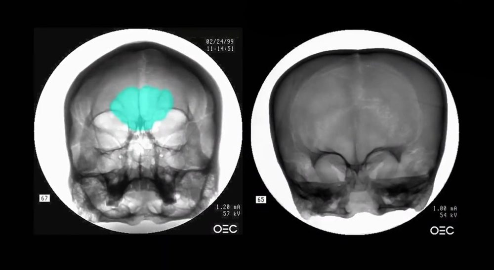 Сравнение рентгеновского снимка черепа человека (слева) с рентгеновским снимком черепа Старчайлда (справа).